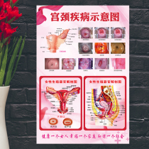 Female genital system anatomy diagram of cervical disease hospital gynecological health knowledge poster poster