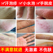 Antifungal ointment fungal infection tinea hand cream fungal infection sulaoketoconazole tablets sweat herpes blisters ointment