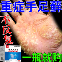 Peeling of hands and feet chapped hands and feet-ringworm fungus bacterial infection antibacterial and antipruritic cream anti-peeling goose palm wind special cream
