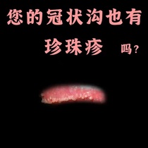 Tortoise Head Leather Blisters Below PEARL RASH CORONARY SULCUS CHIZHEN RARE PEARL GRAIN RASH REMOVAL CREAM MALE PIMPLE PIMPLE PIMPLE RED SWOLLEN