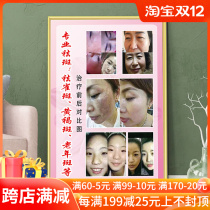 Beauty salon mural painting elderly chloasma freckle treatment before and after contrast picture hanging painting embroidery poster decoration painting customization