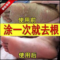 l Baicao Cream Kobayashi beriberi Cream Japanese Beriberi ointment Skin antibacterial cream Beriberi horse oil ointment Beriberi l