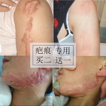 Scar spirit repair cream Hyperplasia raised adenocarcinoma Surgical scar removal bump scar Light melanin precipitation removal of acne marks