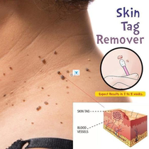 Skin Tag Mole Wart Remover Eye Skin Tag Remover 12 Hours