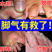 Beriberi ointment Fungal beriberi cure itchy feet stinky peeling blisters rotten feet foot soak powder eradicate stinky feet sweat artifact