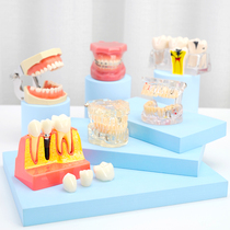 Tooth Model Oral Teaching Kindergarten Swing Piece Gingival Restoration Cultivation Teaching Aids Detachable Children Full Mouth Dental Moldies