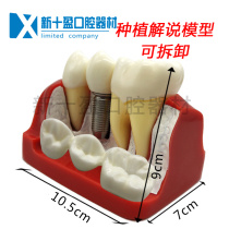 Dentistry 4 Times Cultivation Solutions Model Denture Repair Planting Dental Narrator Detachable Lianbridge Dental Canopy Planting Nails