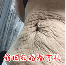 Get rid of stretch marks Repair cream oil Fat lines Growth lines Orange peel lines Eliminate firming prevention of pregnancy and postpartum special