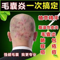Red rash acne seborrheic special medicine chest scalp back root root artifact external medicine