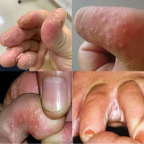Hand peeling repair cream seasonal palm fingers molting