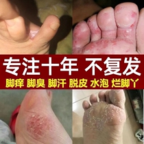 Itchy feet beriberi fungal infection herbal itch Buster home remedies topical sprays for mens sweaty feet children