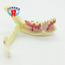 Dental oral teaching model mandibular tissue decomposition model dental nerve gingival semi-openable model
