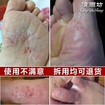 Qingyufang to bubble-type foot Moss itching net fungal infection peeling feet itching rotten feet toes itching itching itching