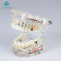 Dental teaching Detachable implant repair model Active tooth implant Dental doctor-patient communication