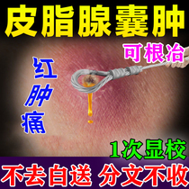 Extraction of sebaceous gland cysts powdery tumor plaster patch for the treatment of subcutaneous folliculitis pustules acne acne acne clogging removal