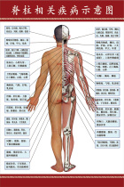 Human spine related diseases poster nervous system diagram blood vessel distribution chart bone wall map hole map