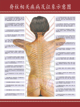 Schematic diagram of spine-related diseases and signs of human acupoint wall chart hospital publicity wall chart