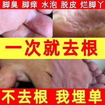 Japanese foot soda expert Foot fungus imported peeling Materia medica to eliminate itching sterilization Childrens sweaty feet