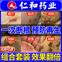 Plantar wart cream monkey bark Thorn monkey special meat pellet spines non-net wart artifact removal