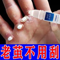 (一滴祛老茧)云南本草老茧去除软化剂去脚掌死皮厚茧去鸡眼疣瘊