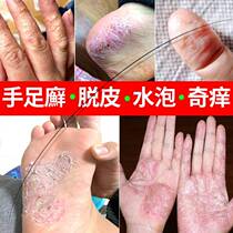 Childrens beriberi special childrens blister-type beriberi ointment root removal artifact Beriberi fungus antipruritic peeling sterilization