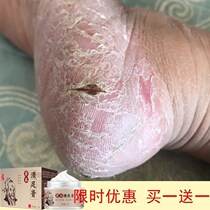 Shu Tuo herbal foot cream Hand and foot moss Itchy skin External care ointment Anti-itch chapped cream