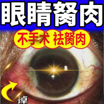 Removal of eye pterygium Eye drops Pterygoid Blurred vision Dry eyes Redness Flesh adenocarcinoma Foreign body sensation Eye drops
