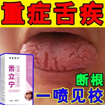 Tongue cracks cracking ulceration inflammation yellowing ulceration medicine to cure cracks tongue tongue tongue foaming tongue coating white and thick
