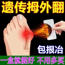 (200% success rate) Thumb Valgus paste to cure large footed bone medicine Toe Straightener Hallux Valgus Special Medicine