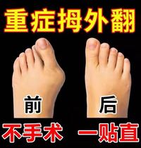Thumb Valgus adhesive finger Outward Correction Sticker Toe Overlap Anti-Wear Large Footed Bone Valgus Special Medicine