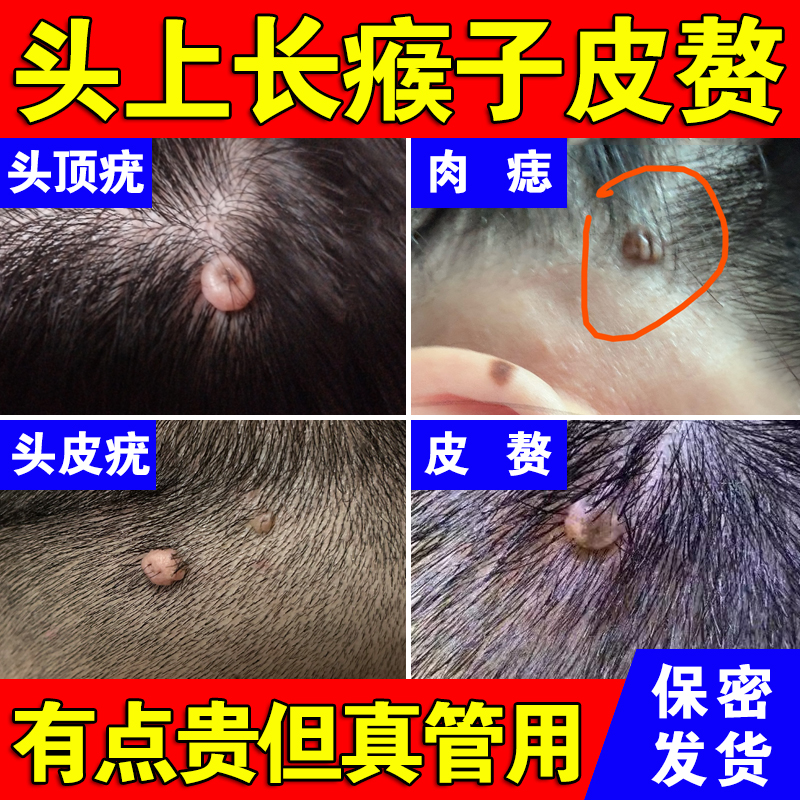 猴子皮肤难题。这款膏药真可达成。