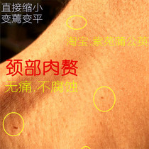 Gentle no scars remove the skin remove the neck long small meat particles meat balls meat treatment of cervical filamentous warts