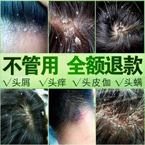 Dedandruff artifact medicine treatment severe dandruff special medicine anti-dandruff anti-itching oil shampoo for men and women