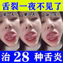 Crack tongue map Tongue tongue nipple stubborn moss Foaming tingling rotten mouth Mouth pain redness Cracking analgesic artifact