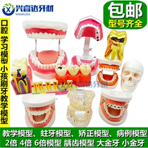 Oral tooth model children brushing teeth teaching tooth model kindergarten teaching aids denture model case caries tooth model