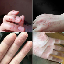 Flawless transformation of cracked hands and feet A touch of recovery heel chapped moisturizing moisturizing foot cream