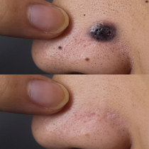 Go to all the black spots on the face no scabs no marks melanin cleansing cleansing oil Buy two get one free