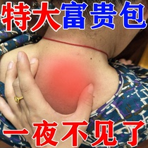 (three days to bag) special treatment to rich and expensive bag elimination of paste fatty neoplasia dredge god instrumental treatment neck patch straightener