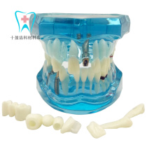 Dental Oral Teaching Blue Implant and Restoration Model Removable Teeth Removable Tooth Pathology