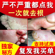 Beriberi ointment root removal itching peeling small blisters sterilization itchy feet rotten feet rotten feet stinky feet dry and cracked feet root breaking artifact