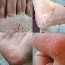 Treatment of the sole of the feet dry cracking peeling dry skin skin skin skin skin cleft heel repair cream