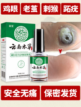 Yunnan materia medica corns paste corns stick to the feet hands toes Japanese soles of the feet not to the feet