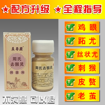 Zhous go to the verruccine cream to get rid of the monkeys meatballs hand foot foot metatarsal chicken eye except for the root deity
