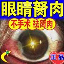 Removal of eye pterygium Eye drops Eye stones Windward tears Flying eye stones windward tears flying wing eye potion