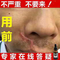 Smooth scar pimple Chest hyperplasia bulge surgery Acne scar cream Ling Scald dilute snow licorice softens