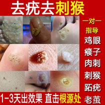 Bai Cao Zhong medical removal of chicken cocoon eye paste cocoon meat thorn Houzi Foot calluses exfoliate foot pads Toe cocoons