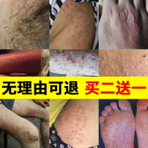 Special Miao Fang Qingdu treatment of elbow Moss adult fungal antipruritic ointment for external use of cowhide feet root net fresh ringworm