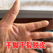 Peeling hands Peeling skin Peeling Molting Hands and feet Cracking Chapped Dry repair cream Seasonal hand care Exfoliation