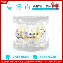 Malocclusion orthodontic tooth model dental model dental model dental model dental model dental model