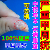 Chia Zhou Warts Special Medicine Removal of Foot and Bottom Metatarsal Metatarsal of the Metatarsal of Genital Warts Chia Gou of Zhou wart Wart Embed of Fingers Wart Meat